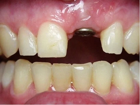 dental-implants-1.1