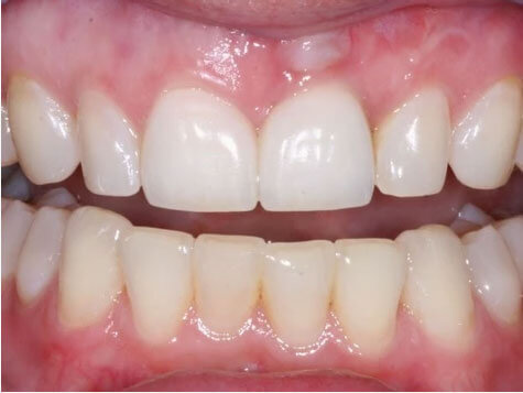 dental-implants-1.2