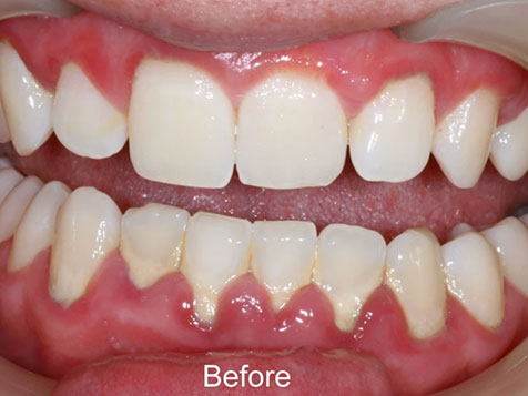 gum-diseases-before