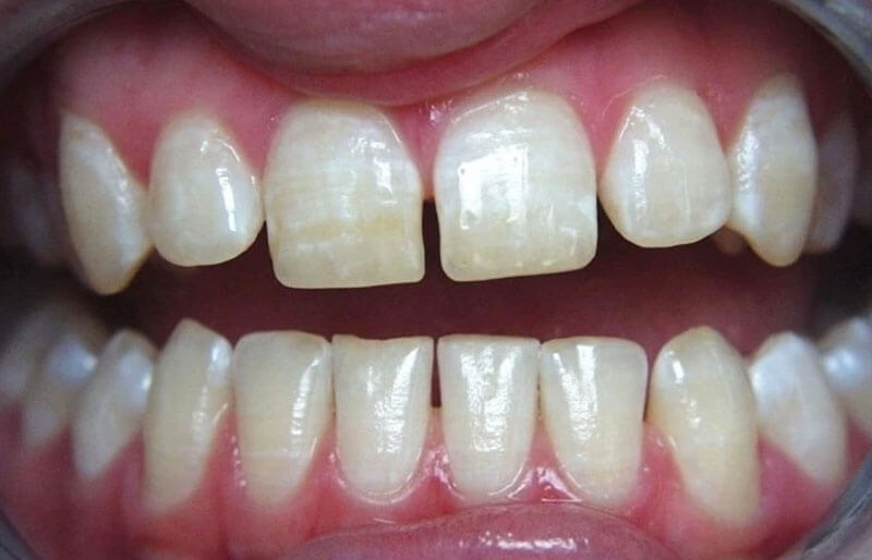 Teeth Images