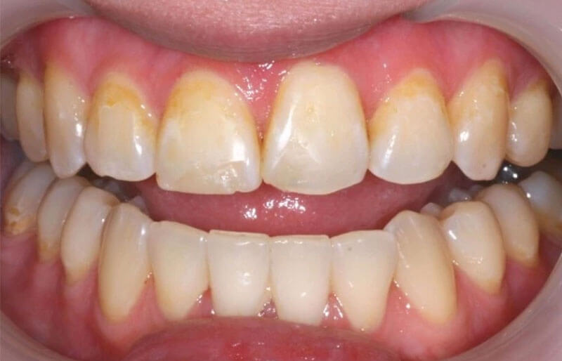 Teeth Images