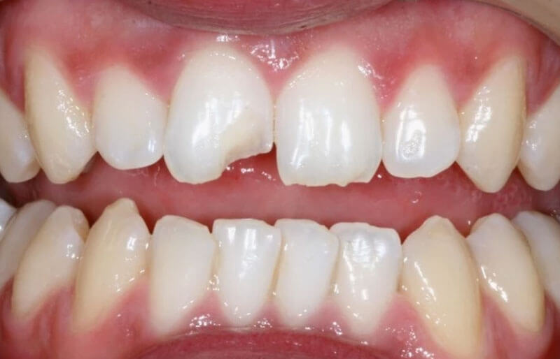 Teeth Image