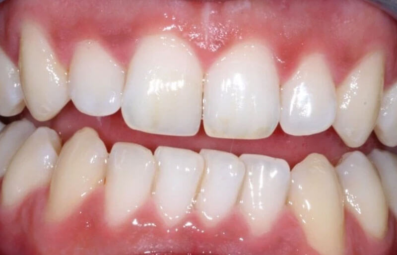 Tooth-Coloured-fillings02