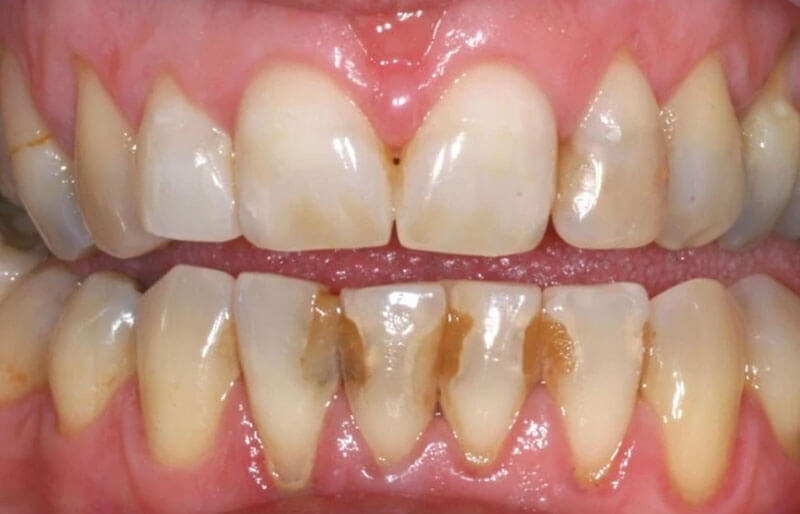Tooth-Coloured-fillings05