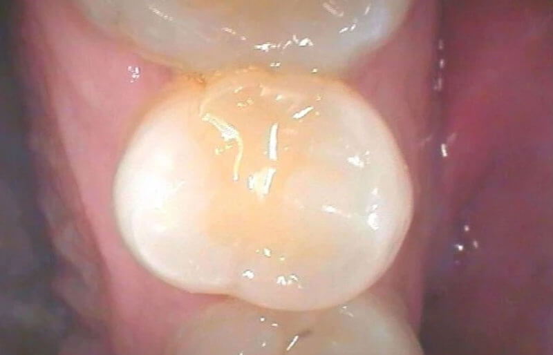 Tooth-Coloured-fillings07