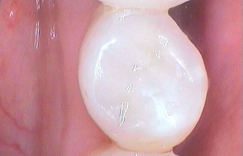 Tooth-Coloured-fillings10