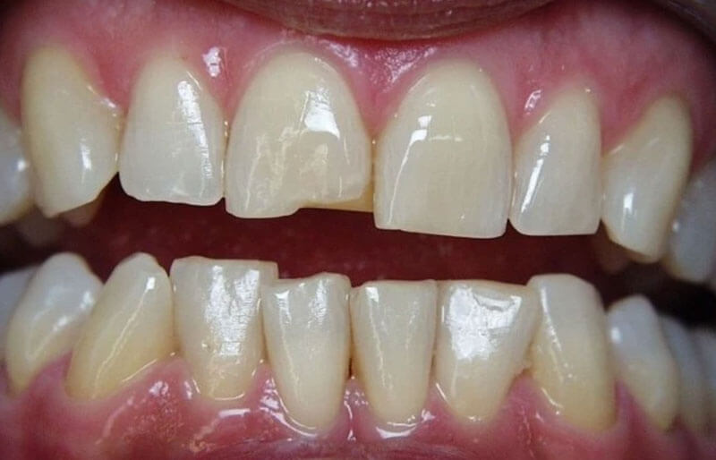 Tooth-Coloured-fillings11