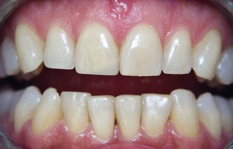 Tooth-Coloured-fillings12