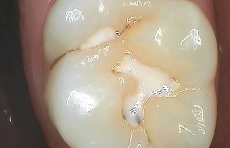 Tooth-Coloured-fillings13