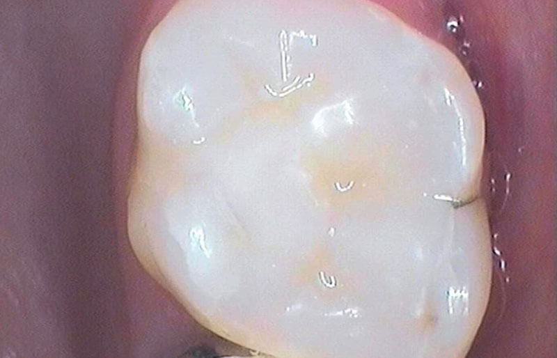 Tooth-Coloured-fillings18