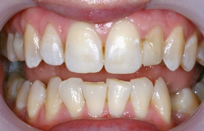 Dental Crowns Image