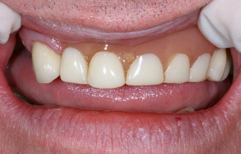 dentures-set1.1