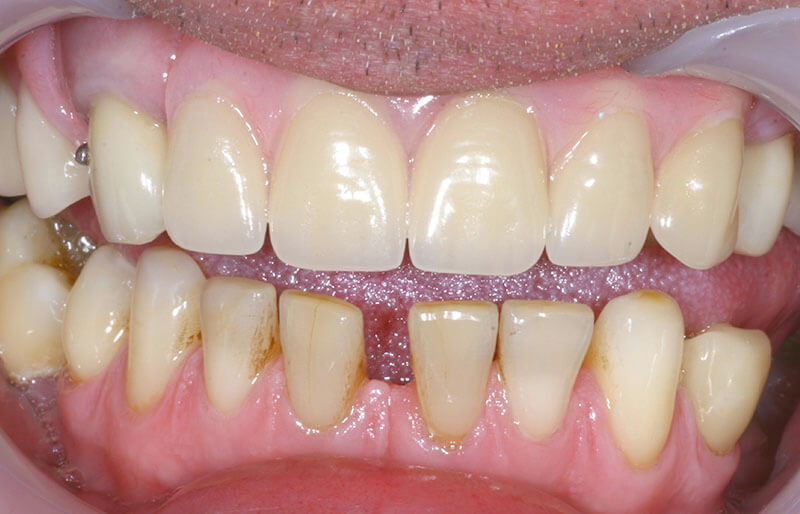 dentures-set1.2