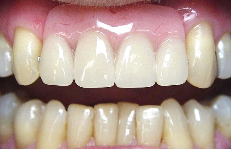 dentures-set2.1