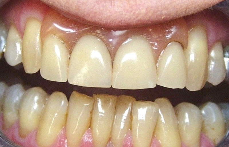 dentures-set2.2