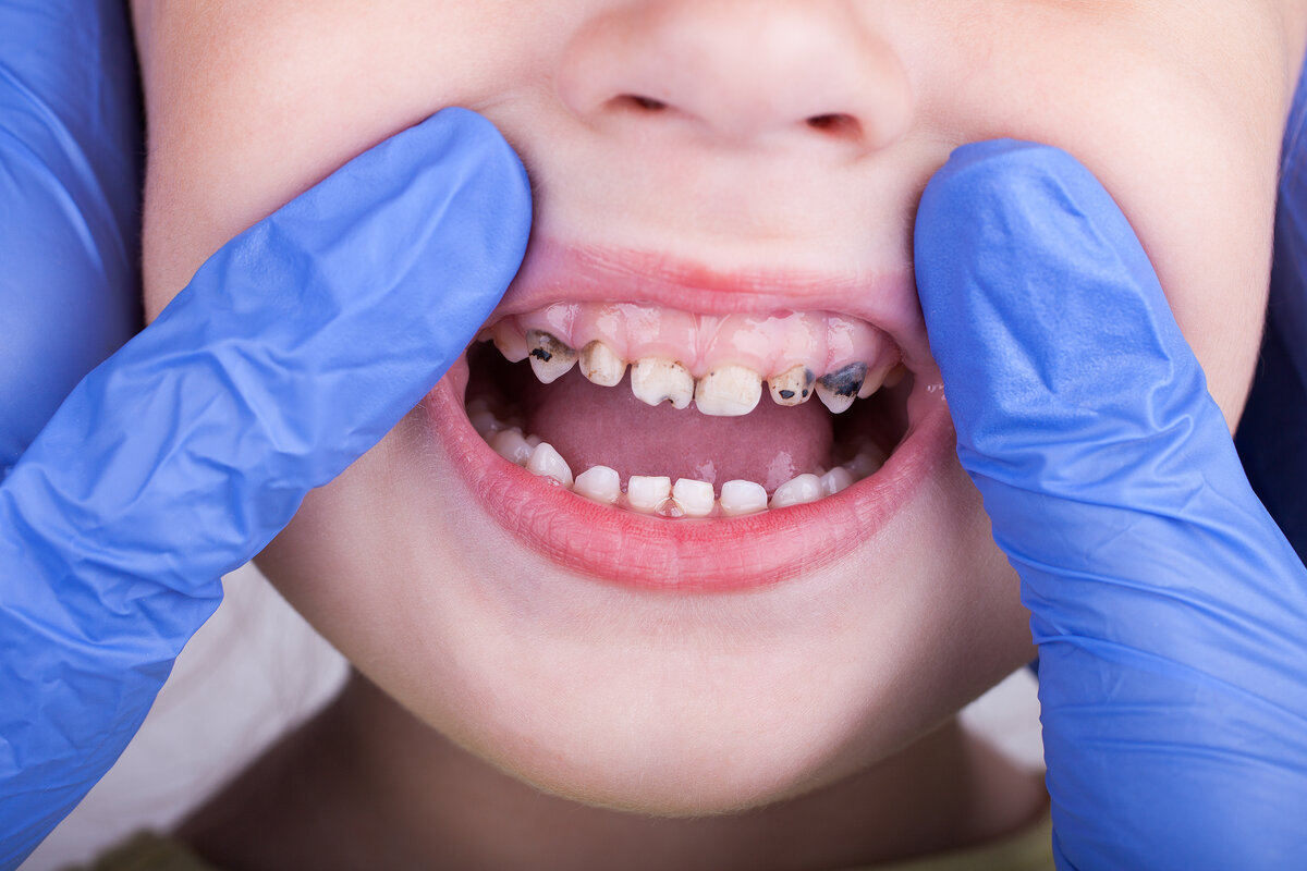 The Signs And Symptoms of Tooth Decay in Children